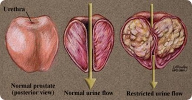 Numai că a existat un tratament eficient pentru prostatita cronica