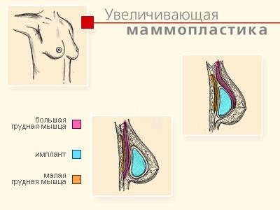 Sânilor preț augmentare și operațiunile de recenzii mamoplastia