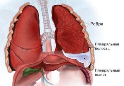 Pneumonie periculoasă, pneumonie 03