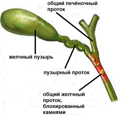 камъни в жлъчката симптоми