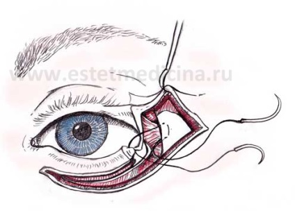 pleoape Canthopexy recomandările experților (superioare și inferioare), revista on-line (inferior) pleoape Canthopexy recomandările experților (superioare și inferioare), revista on-line