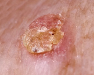 Tratament keratozele solare (tratament) Tratamentul keratozei solare