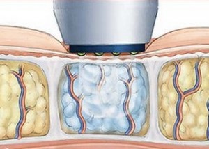 Tehnici de liposuctia procedurii