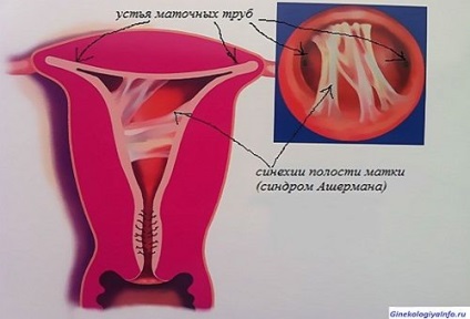 Sindromul Asherman cauzează siptomy, tratamentul aderențelor intrauterine