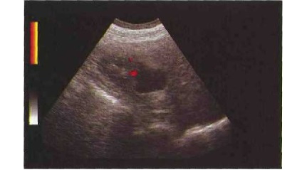 Diagnostic cu ultrasunete de chisturi renale (artera renală dreapta) Diagnostic cu ultrasunete de chisturi renale