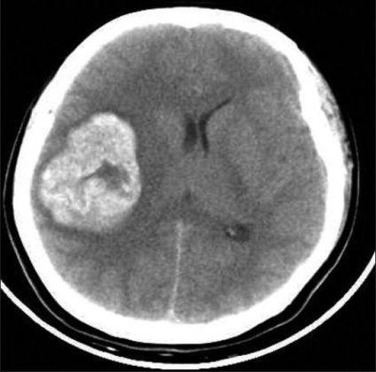 hematom intracranian cauze, diagnostic, tratament și consecințe