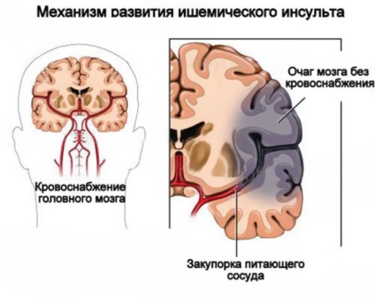 Cauzele cronice ischemiei cerebrale, simptome, stadii, diagnostic, tratament