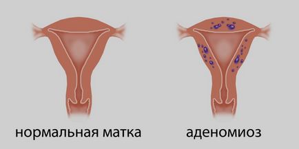 Аденоміоз матки - що це таке, симптоми і лікування