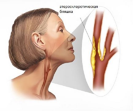 Атеросклероз сонних артерій або холестеринових бляшка в сонній артерії що це, лікування