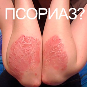 Бляшкової псоріаз що це таке і як його лікувати (таке) Бляшкової псоріаз що це таке і як його лікувати