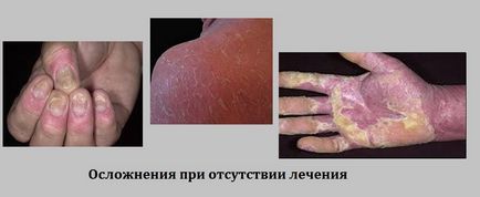 Бляшкової псоріаз що це таке і як його лікувати (Крім того захворювання) Бляшкової псоріаз що це таке і як його лікувати