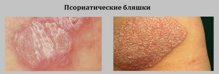 Бляшкової псоріаз що це таке і як його лікувати (Крім того захворювання) Бляшкової псоріаз що це таке і як його лікувати