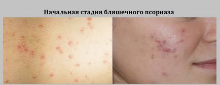 Бляшкової псоріаз що це таке і як його лікувати (таке) Бляшкової псоріаз що це таке і як його лікувати