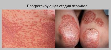 Бляшкової псоріаз що це таке і як його лікувати (бляшкової) Бляшкової псоріаз що це таке і як його лікувати