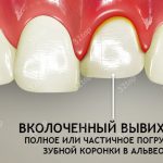 Болить щелепу при відкритті рота 6 основних причин