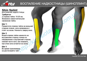 Біль в окістя при бігу (окістя) Біль в окістя при бігу