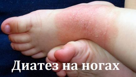 Діатез на ногах у дитини (фото) (діатез ногах дитини) Діатез на ногах у дитини (фото)