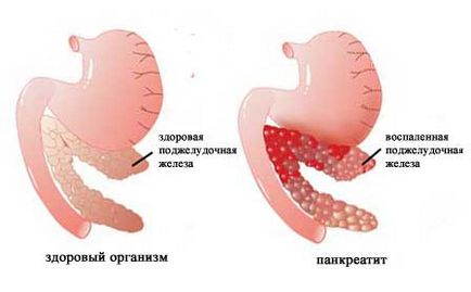 Дієта при болях в підшлунковій залозі - що можна їсти (залозі) Дієта при болях в підшлунковій залозі - що можна їсти