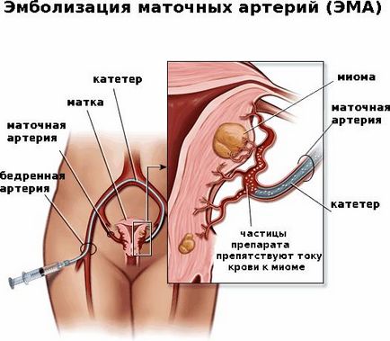 Як зупинити кровотечу при міомі матки (день чайні ложки) Як зупинити кровотечу при міомі матки