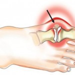 Як зняти біль при подагрі