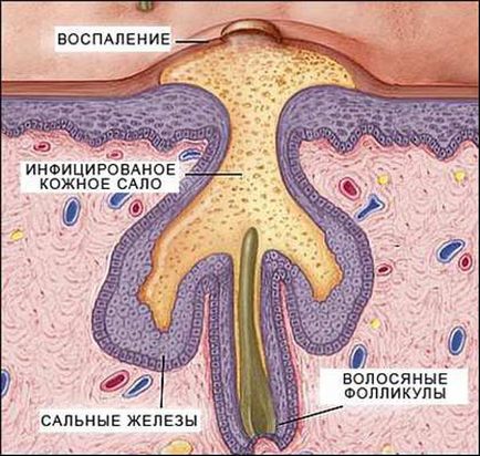 Кислота від прищів - саліцилова, відгуки, борна, як користуватися, застосування