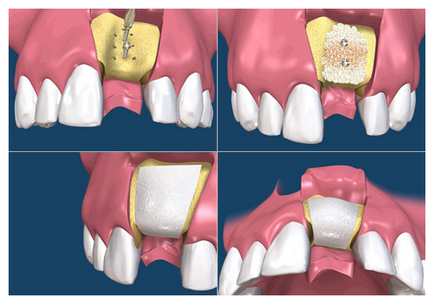 Кісткова пластика при імплантації зубів