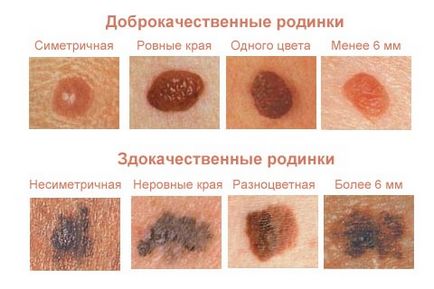 Червона родимка на тілі - що це причини появи і лікування народними засобами (родимка) Червона родимка на тілі - що це причини появи і лікування народними засобами