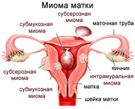 Кровотеча при міомі матки як зупинити, лікування