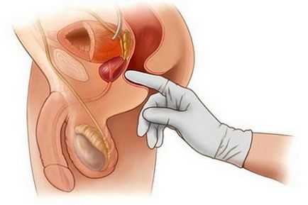bélpálca és prostatitis hemo a gyertyákról prostate vélemények