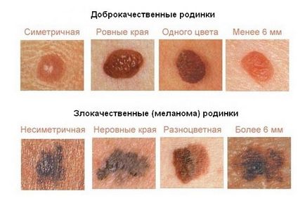 Чи можна видаляти родимки на обличчі види утворень, способи позбавлення, заборони (чи можна видаляти опуклі родимки на обличчі) Чи можна видаляти родимки на обличчі види утворень, способи позбавлення, заборони