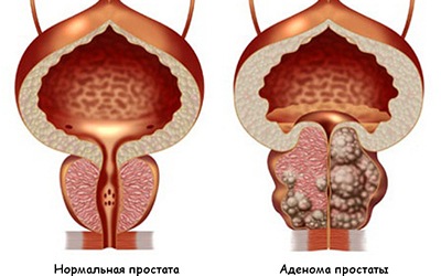 Adenoma prosztatagyulladás kezelése A prosztatagyulladás adenoma kezelése