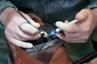 Ускладнення місцевої анестезії, причини, ризик (профілактика ускладнень анестезії) Ускладнення місцевої анестезії, причини, ризик