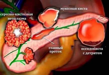 Поліпи в підшлунковій залозі причини (підшлункової) Поліпи в підшлунковій залозі причини