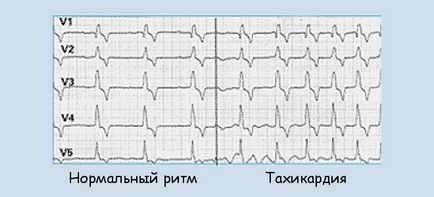 Після їжі частішає серцебиття причини (частішає) Після їжі частішає серцебиття причини