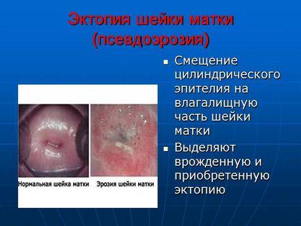 Псевдоерозія шийки матки причини та лікування захворювання