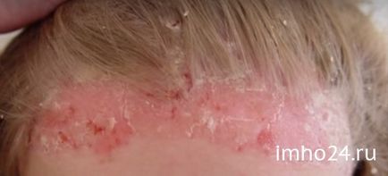 Psoristop від псоріазу відгуки (відгук Відгуків швидких) Psoristop від псоріазу відгуки