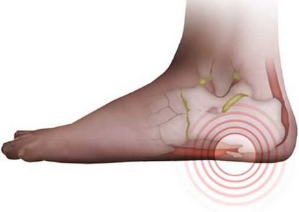 П'яткова шпора (плантарний, підошовний фасциит) причини виникнення, ознаки