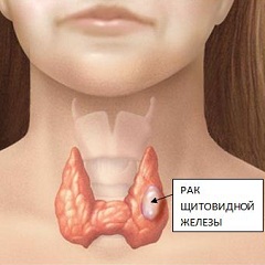 Рак щитовидної залози - симптоми, лікування, метастази