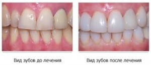 Реставраційне відбілювання зубів - відгуки, ціни, фото до і після (зубів) Реставраційне відбілювання зубів - відгуки, ціни, фото до і після
