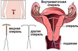 Спіраль внутрішньоматкова - відгуки та рекомендації (спіраль) Спіраль внутрішньоматкова - відгуки та рекомендації