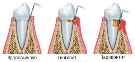 Хірургічне лікування пародонтиту, сучасні методи та етапи лікування, операції на здорових або (сучасні) Хірургічне лікування пародонтиту, сучасні методи та етапи лікування, операції на здорових або