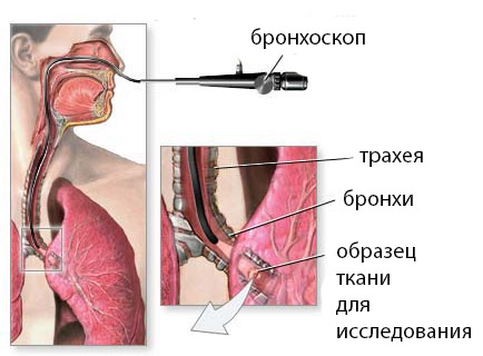 Біопсія легень показання (при раку, саркоїдозі), хід і результати