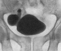 Vezicii urinare diverticul - cauze, simptome, diagnostic și tratament