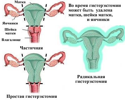 Фіброміома матки - причини, симптоми і лікування