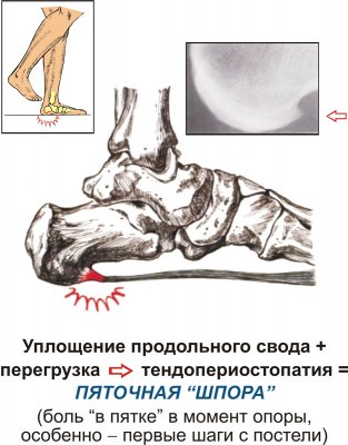 Як позбутися від шпор (шипів) на ногах