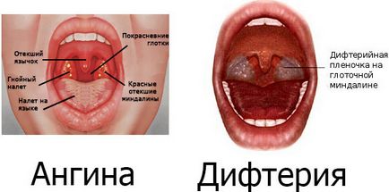 Як відрізнити ангіну від дифтерії і чим лікують ці захворювання