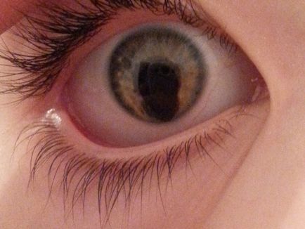 Coloboma a irisului și secole cum să recunoască această boală