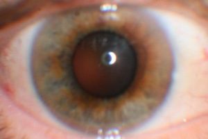 Coloboma irisului, cristalinului, și un ochi foto-lea, cauze si tratament