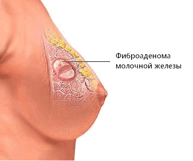 Tratamentul metodelor fibroadenom mamar fără intervenție chirurgicală