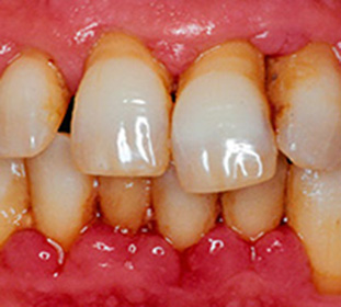 Пародонтит класифікація (хронічний, генералізований і інші), причини, симптоми, а також